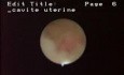 Hysteroscopic Aspect Of Female Genital Tuberculosis