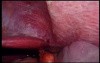 Colonic Perforation With Peritonitis - Laparoscopy (38 of 46)