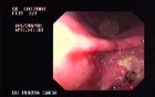 Ulcerative Pre - Pyloric Adenocarcinoma