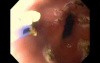 Endoscopy of Mallory Weiss Tear - Status Post Coagulation