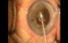 Pupil creation with Fugo plasma blade