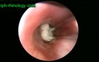 Bronchoscopy In A 15 Months Old Child