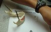 Intraosseous Anesthesia - Stabident/XTip
