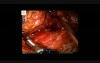 Robotic Redo Mesh Rectopexy