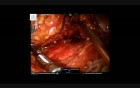 Robotic Redo Mesh Rectopexy