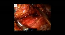 Robotic Redo Mesh Rectopexy