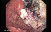 Esophageal Squamous Cell Carcinoma - Precise Assessment of the Tumor