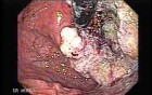 Esophageal Squamous Cell Carcinoma - Precise Assessment of the Tumor