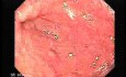 Gastric Varices - Endoscopic Ablation With Cyanoacrylate Glue (18 of 18)