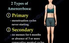 Female Athlete Triad 