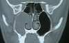 Choanal Polyp - Endoscopic Removal