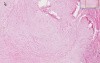 Keloid - Histopathology - Skin