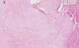Keloid - Histopathology - Skin