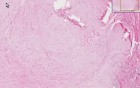 Keloid - Histopathology - Skin
