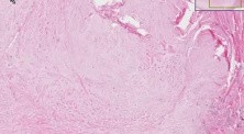 Keloid - Histopathology - Skin