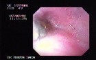 Esophageal Achalasia (1 of 7)