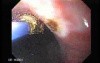 Gastric Polyposis - Endoscopy (11 of 11)