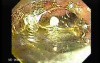 Dental Prothesis Found in the Jejuno (4 of 9)