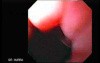 Esophageal Achalasia - Final Stage of Balloon Dilation