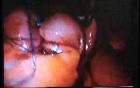 Jejunal Gastrointestinal Stromal tumor (GIST) (80 of 86)