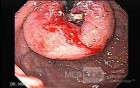 Gastric Cancer