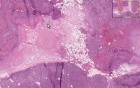 Acute Pancreatitis 2