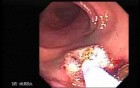 Cap polyposis that resemble a adenocarcinoma of the rectum (6 of 7)