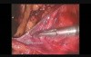 Totally Extraperitoneal Hernia Repair