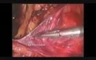 Totally Extraperitoneal Hernia Repair