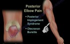 Common Causes of Elbow Pain - Video Lecture
