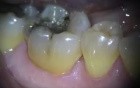 Papillomas and POF Removal