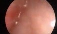 Vaginal Bleeding Caused By Polyp of the Endometrium