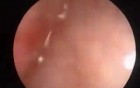 Vaginal Bleeding Caused By Polyp of the Endometrium