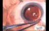 Glaucoma TCF Surgery with use Fugo Blade
