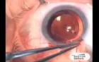 Glaucoma TCF Surgery with use Fugo Blade
