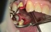 Provisional Immediate Implant After Tooth Extraction