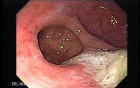 Gastric Diverticulum - Endoscopy