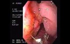 Enormous Tubulovillous tumor (1 of 2)