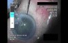 Cataract Surgery XII - Part 3