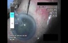 Cataract Surgery XII - Part 3