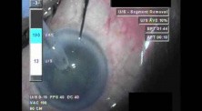 Cataract Surgery XII - Part 3