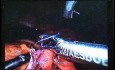 Jejunal Gastrointestinal Stromal tumor (GIST) (54 of 86)