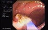 Tubulo - Villous Adenoma - Endoscopy (13 of 28)