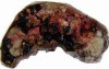 Gallbladder Adenocarcinoma and litiasis (3 of 13)