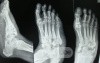 Charcot's foot
