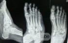 Charcot's foot