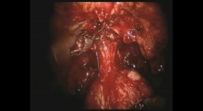 Robotic prostatectomy in HD - DaVinci Surgery - part 2