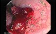Endoscopic Resection of Giant Tubulo-Villous of the rectum (8 of 35)