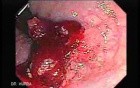 Endoscopic Resection of Giant Tubulo-Villous of the rectum (8 of 35)