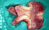Endoscopy of Scirrhous Gastric Carcinoma involving the entire Fundus, Body and the Antrum (37 of 47)